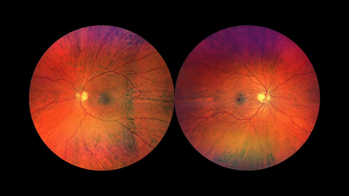 Dal Timing Della Chirurgia Della Macula A Una Nuova Classificazione Per